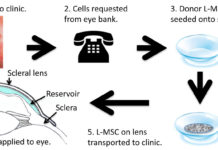 A new therapeutic contact lens that acts as a bandage for eye surface injuries