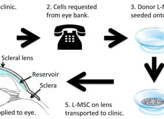 A new therapeutic contact lens that acts as a bandage for eye surface injuries