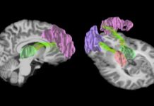 A single season of high school football may be enough to cause microscopic changes in the structure of the brain