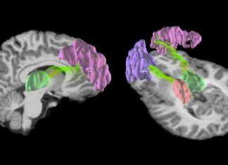 A single season of high school football may be enough to cause microscopic changes in the structure of the brain