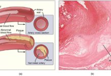 A study has shown that it may be possible to detect the early signs of atherosclerosis which leads to blocked arteries