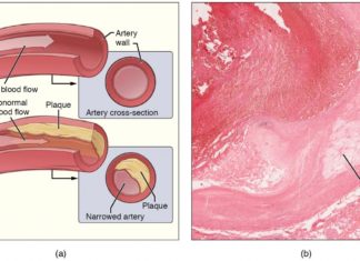 A study has shown that it may be possible to detect the early signs of atherosclerosis which leads to blocked arteries