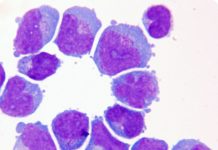 Five percent of acute leukemia cases are diagnosed as mixed lineage leukemia (MLL)