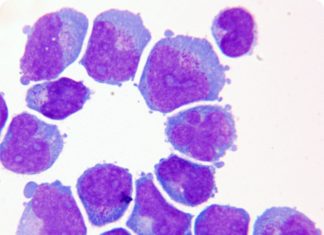 Five percent of acute leukemia cases are diagnosed as mixed lineage leukemia (MLL)