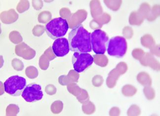 Acute myeloid leukemia (AML) – 91 percent response rate to the combination of venetoclax with azacitidine