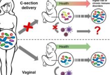 Altered microbiome after caesarean section impacts newborn immune system