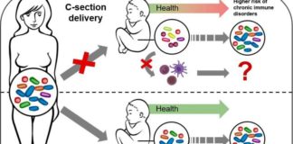 Altered microbiome after caesarean section impacts newborn immune system