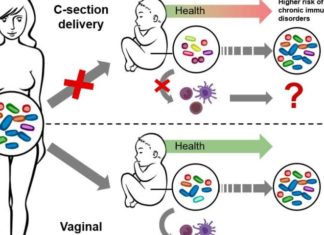 Altered microbiome after caesarean section impacts newborn immune system