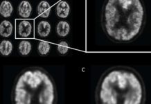 Artificial intelligence (AI) technology improves the ability of brain imaging to predict Alzheimer’s disease