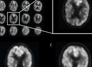 Artificial intelligence (AI) technology improves the ability of brain imaging to predict Alzheimer’s disease