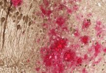 DNA vaccine reduces accumulation of both types of toxic proteins associated with Alzheimer’s disease