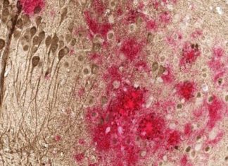 DNA vaccine reduces accumulation of both types of toxic proteins associated with Alzheimer’s disease