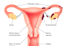 Researchers at Northwestern Medicine have taken the first step in bioengineering the human uterus to treat endometriosis, uterine-factor infertility and endometrial cancer
