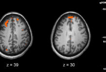 Genetics can be used to predict a patient’s response to antipsychotic drug treatment for schizophrenia