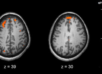 Genetics can be used to predict a patient’s response to antipsychotic drug treatment for schizophrenia
