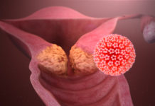 Standard chemotherapy used to treat a specific type of throat cancer remains the most effective