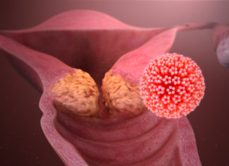 Standard chemotherapy used to treat a specific type of throat cancer remains the most effective