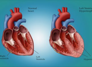 Left ventricular hypertrophy (LVH), also known as an enlarged heart, is associated with a nearly two times higher risk of dementia