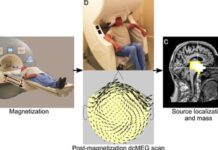 Magnetoencephalography (MEG) – Advanced imaging technology measures magnetite levels in the living brain