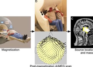 Magnetoencephalography (MEG) – Advanced imaging technology measures magnetite levels in the living brain