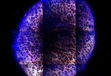 Osteoarthritis – MIT engineers have designed a new material that can administer drugs directly to the cartilage
