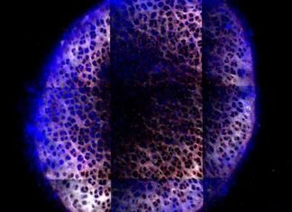Osteoarthritis – MIT engineers have designed a new material that can administer drugs directly to the cartilage
