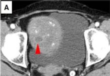 Researchers find new way detect early melanoma growth
