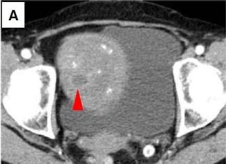 Researchers find new way detect early melanoma growth