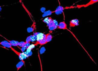 Researchers identified the cascade of cell death events leading to the physical and intellectual degeneration associated with Parkinson’s disease