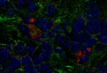 Researchers in Israel have discovered that breast tumors can boost their growth by recruiting stromal cells originally formed in the bone marrow