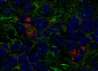 Researchers in Israel have discovered that breast tumors can boost their growth by recruiting stromal cells originally formed in the bone marrow