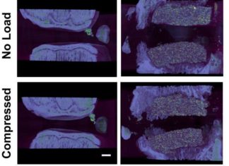 For the first time, bioengineered spinal discs were successfully implanted and provided long-term function for tissue-engineered disc replacement