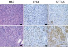 Pancreatic cancer’s addiction could be its end – identified a gene called Tumor-Protein 63 (TP63) that is specifically expressed in this aggressive form of pancreatic cancer