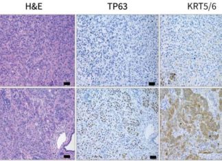 Pancreatic cancer’s addiction could be its end – identified a gene called Tumor-Protein 63 (TP63) that is specifically expressed in this aggressive form of pancreatic cancer