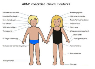 A new Tel Aviv University study finds that the drug candidate CP201, also known as NAP, may improve vocal communication abilities that are underdeveloped in ADNP patients