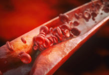 Atherosclerosis : Research team found that non-coding sequence of DNA – rs17114036 plays a significant role in human disease incidence