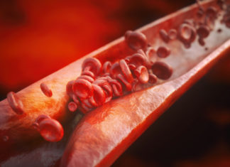 Atherosclerosis : Research team found that non-coding sequence of DNA – rs17114036 plays a significant role in human disease incidence