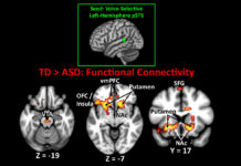 Researchers believe the symptoms of autism may result from sustained connections between regions of the brain