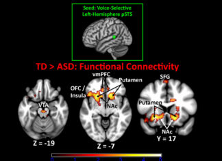 Researchers believe the symptoms of autism may result from sustained connections between regions of the brain