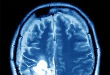 A team of researchers have found a solution that could halt spread of brain cancer