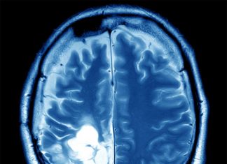 A team of researchers have found a solution that could halt spread of brain cancer