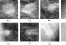 Using technology similar to the type facial and speech recognition, scientists trained a computer to classify breast cancer tumors