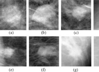 Using technology similar to the type facial and speech recognition, scientists trained a computer to classify breast cancer tumors