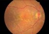 Calcified nodules in the retina are associated with progression to late stages of age-related macular degeneration (AMD)