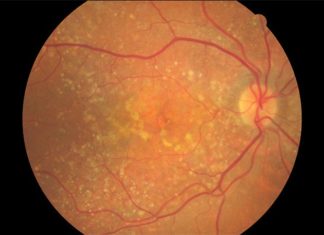 Calcified nodules in the retina are associated with progression to late stages of age-related macular degeneration (AMD)