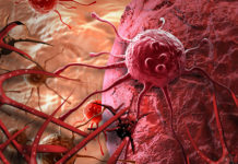 Research on a bacterial toxin has led to the development a new blood test for the early diagnosis of ovarian cancer