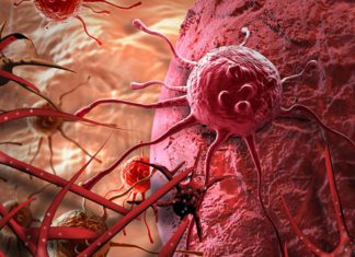 Research on a bacterial toxin has led to the development a new blood test for the early diagnosis of ovarian cancer