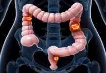 Screening for colorectal cancer reduce the need for chemotherapy and emergency surgeries among male patients