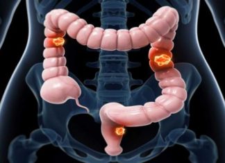 Screening for colorectal cancer reduce the need for chemotherapy and emergency surgeries among male patients