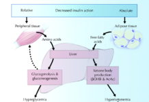 Type 1 diabetes : Diabetic Ketoacidosis (DKA) – an enemy always lurking
